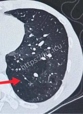 三十年顽固咳嗽